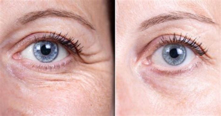Discover The Secrets Of Jelly Roll Botox: Unlocking Youthful Radiance